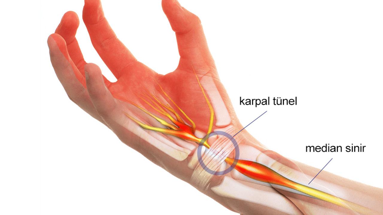 Karpal tünel sendromu nedir, neden olur? Karpal tünel sendromuna ne iyi gelir, tedavisi nedir?