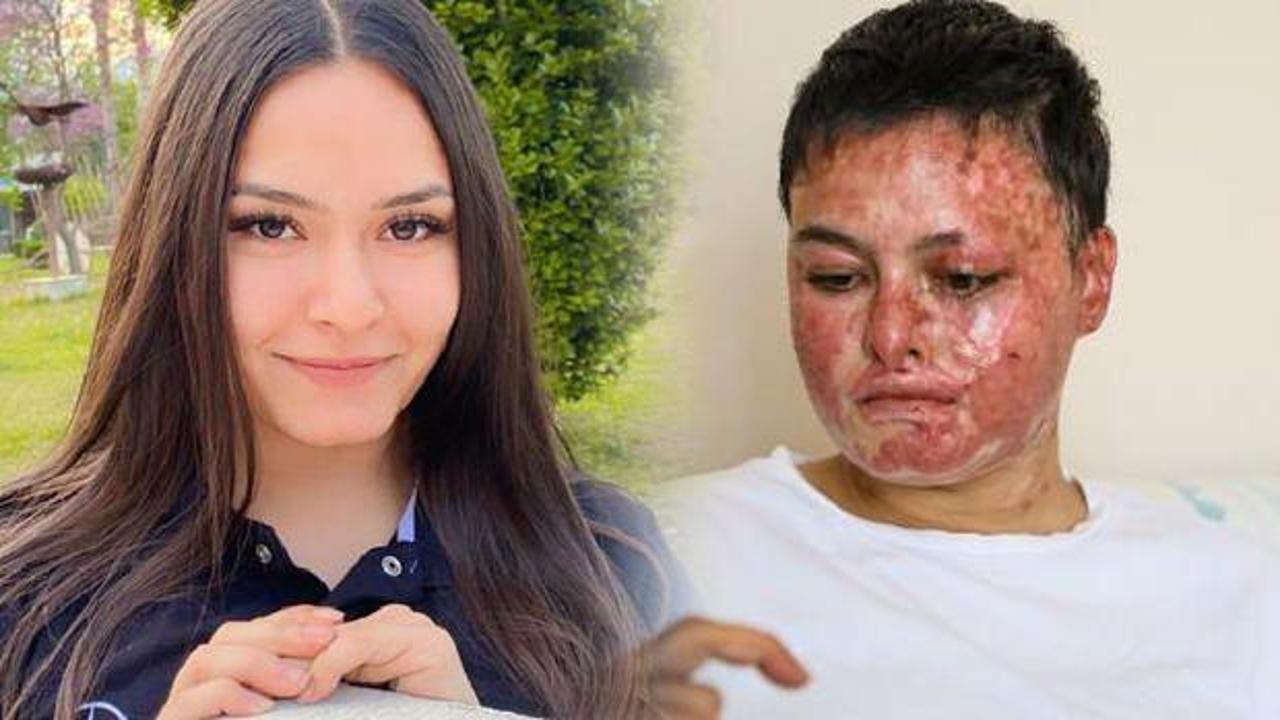 Çalıştığı araç servisinde dehşeti yaşadı! Vücudunun büyük bölümü yandı