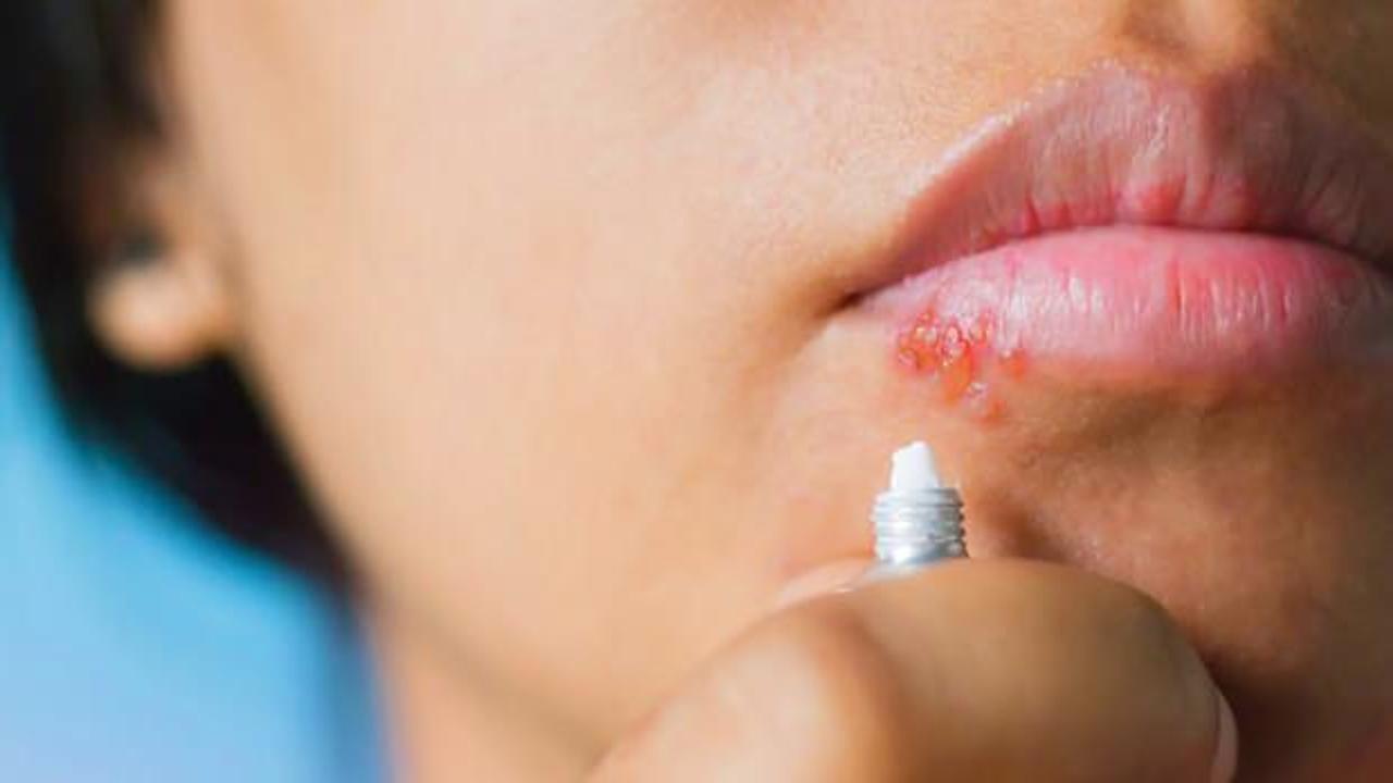 Dudakta uçuk neden çıkar, nasıl geçer? Stresten dudak uçuklaması hangi hastalığın belirtisidir?