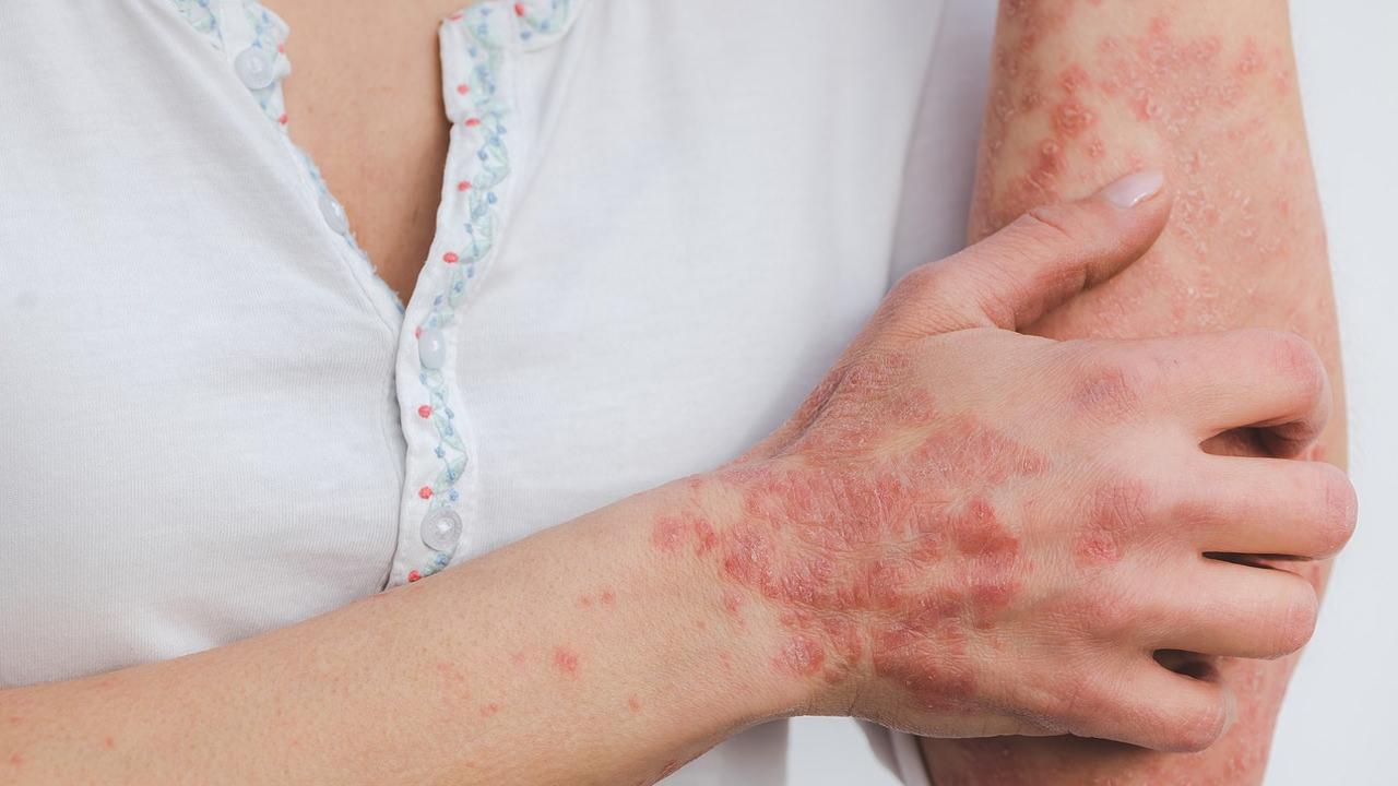 Lupus hastalığı nedir, belirtileri nelerdir? Lupus hastalığı öldürücü müdür, tedavisi nedir?