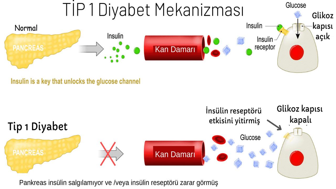 Tip 1 diyabet nedir, belirtileri nelerdir? Tip 1 diyabet geçer mi, tedavisi nedir?