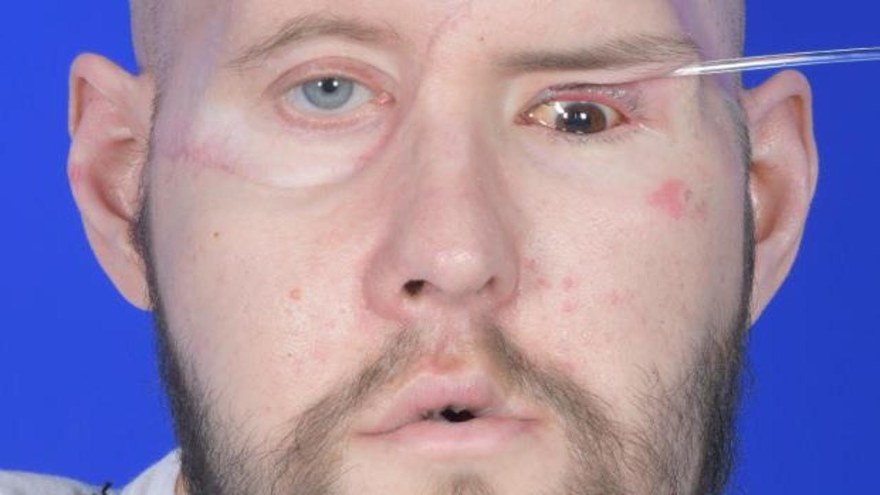 ABD’de bir hastaya 21 saat ameliyatla ‘tam göz’ nakli yapıldı