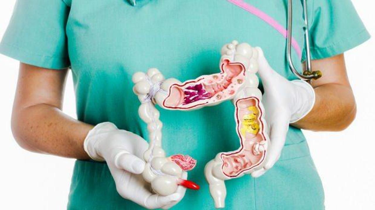 Apandisit nedir, neden olur? Apandisit patlaması belirtileri…