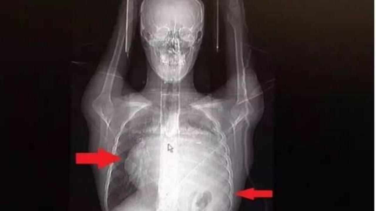 Kalbi 12 cm kaydı! Doktorlar bile şaşkın! İstanbul’da müdahale edildi