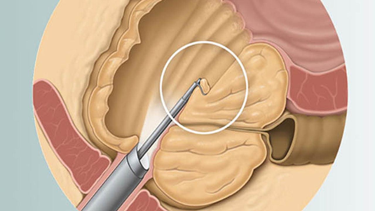 Prostat Hastalığında bir devrim! HoLEP ameliyatı nasıl yapılır?