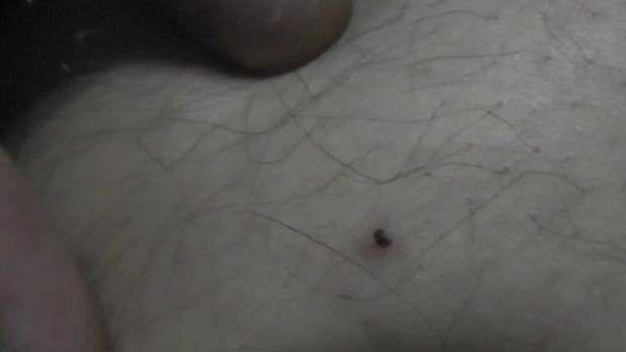 Havaların ısınmasıyla artmaya başladı! Yılın ilk vakası