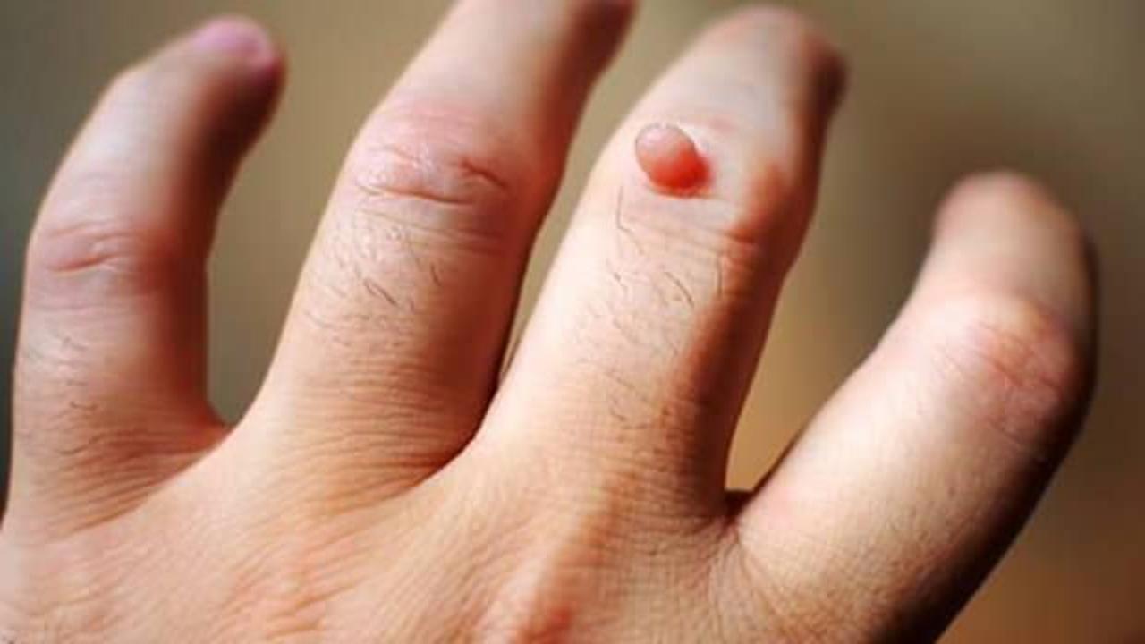 Siğil nasıl geçer? Evde doğal siğil tedavisi…