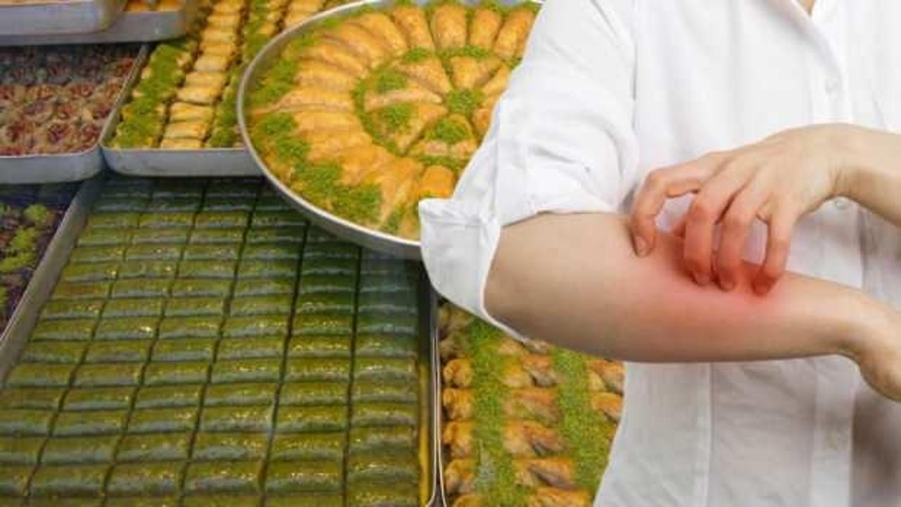Uzmanlardan dikkat çeken bayram uyarısı! Aşırı tatlı tüketimi gıda alerjisine neden oluyor