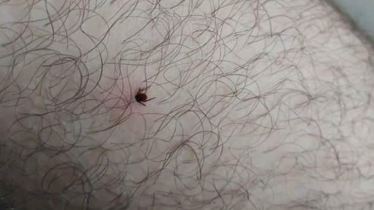 Kene ısırması vakalarında yanlış yöntem ölüme götürüyor