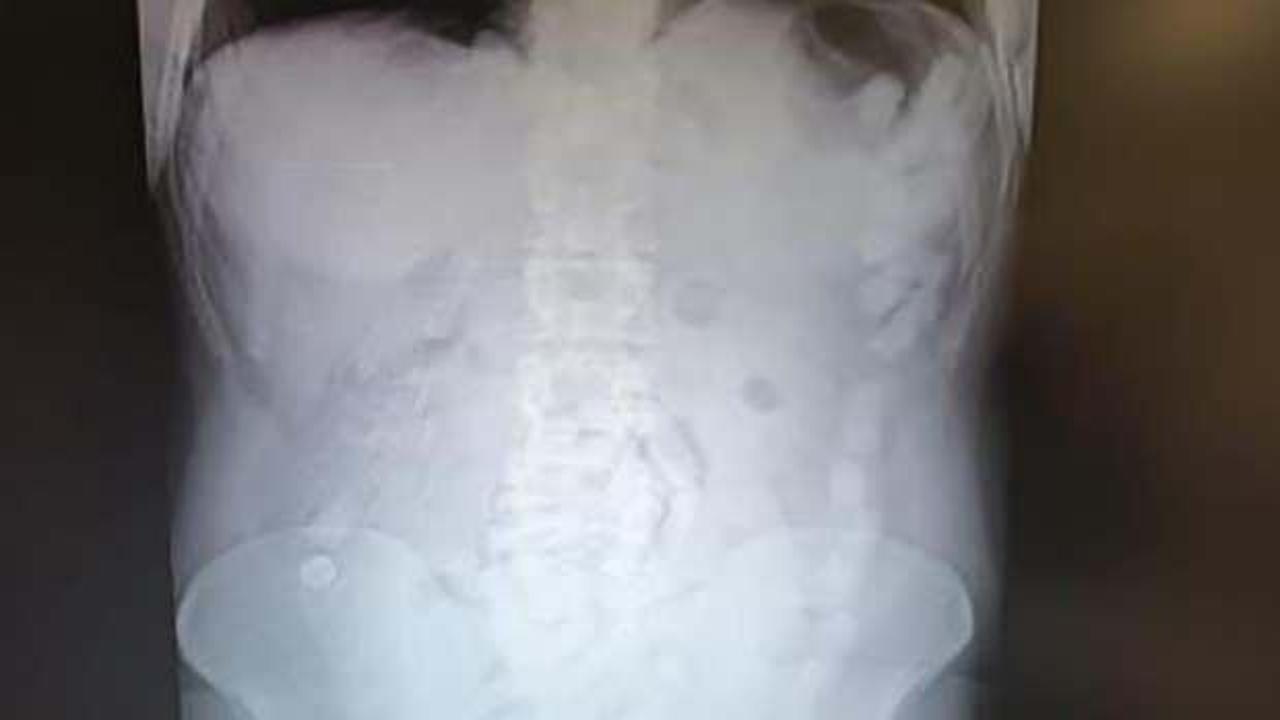 Tam 100 adet! Midesinde 729 gram uyuşturucuyla yakalandı