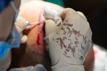 Yüksek Kalitede Saç Ekimi: Clinista Saç Ekim Merkezi’nin Standartları